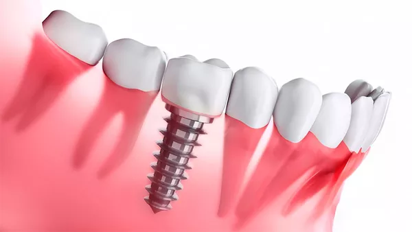 Установка сучасних зубних імплантів у Черкасах з наданням гарантії